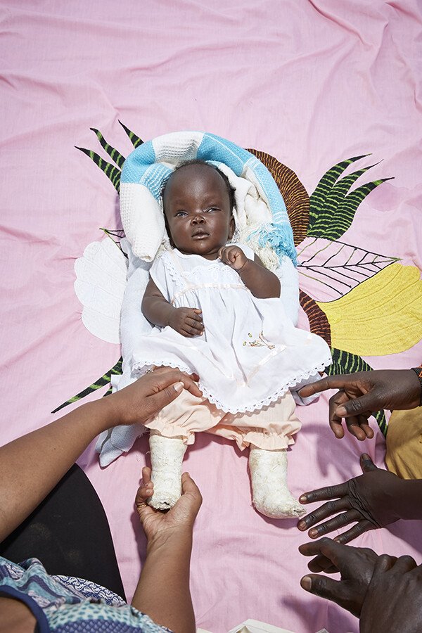 A baby is treated using the Ponseti method, which involves stretches and casts to correct her feet