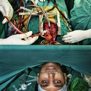 Man undergoing a pioneering form of open-heart surgery