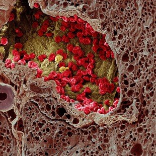 Blood vessel in a melanoma, SEM