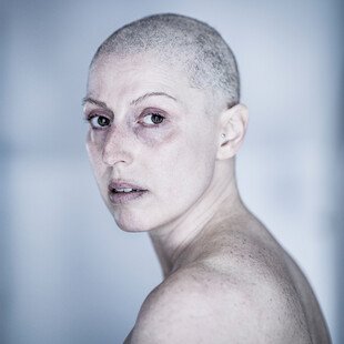 Portrait of a woman with breast cancer, who has lost her hair due to chemotherapy.